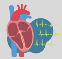 Read more about the article Rhythm Rescue – Insights to Atrial Fibrillation